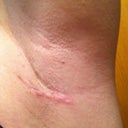 Left incision