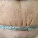 wrinkled scar
