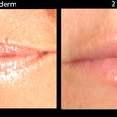 No more prune lips after 1 syringe of Juvederm!!!