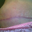 15 week po scar