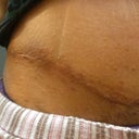 Right side of scar