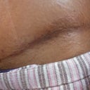 Left side of scar with rash