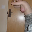 four weeks post op