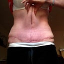 How much skin I can grab! Post op?