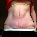 Uneven post op