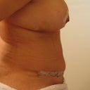 10 days post op