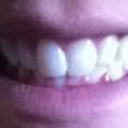 Before, top teeth totally covered my bottom teeth and was uncomfortable to bite down all the way.