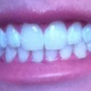 After, no more deep bite and my front teeth are no longer grinding into each other on the inside.