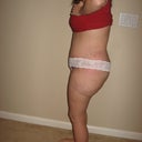 post op day#13