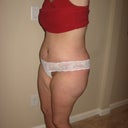 post op day #13