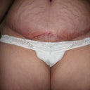 post op day #13