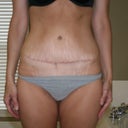 4 months-scar