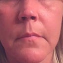 This is two years after he performed his surgery. He said since my skin was so great, that I was an “ideal candidate.” Ah, two yrs later....looks like I need another one!