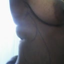 side view mark-up before surgery