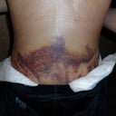 Lower back bruise