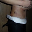 Side shot four days post op