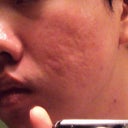 May 9, 2012 - 11 days after procedure

This is the right side of my face (reflected in a mirror) given the worst possible lighting.
