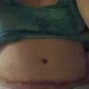my scar end of 2nd week... and my slow to heal belly button. Looking a bit swollen.