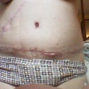 End of wk 3... you can see where incision has opened up and is yellow... maybe the fat under skin? It grosses me out totally! most of scar looks good, especially on sides.  Belly Button still sllllooooowwly healing.