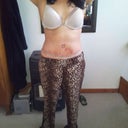 7 days post op