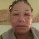 skin darkening and peeling off