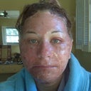 greasy ointment, skin peeling off