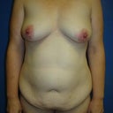 Pre-surgery