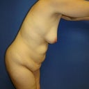 Pre-surgery