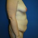 Pre-surgery