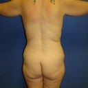 Pre-surgery