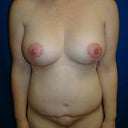 3 months post-op