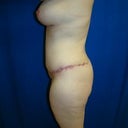 3 months post op
