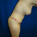 3 months post op