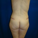 3 months post op