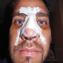 Post-op +4. Looking pretty much the same.