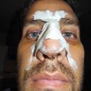 Post-Op +5. Again it pretty much looks the same. Maybe the bruising has gone down some. The left nostril is bigger and there are quite a few blue splints on there.