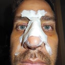 Post-Op +6. Not too much has changed. Getting the inside splints removed tomorrow.