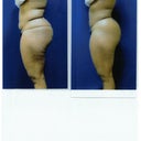 Before and After