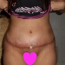 3 week.. Very swollen