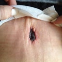 belly button postop day 1
