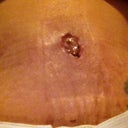belly button postop day 13