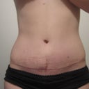 1 month post op, wrinkles are from tape