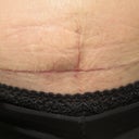horizontal and vertical scars. there's a hard bulge there ...