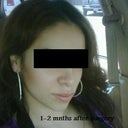 1-2 months after surgery