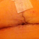 T section at 14 days post op