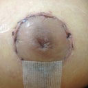 16 days post op