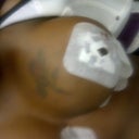 Straight after OP ( right breast)