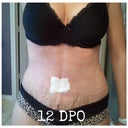 12 weeks PO: progression pics are the best way to snap out of a post operative funk!!