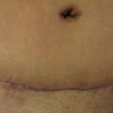 front of my scar and bb you can also see to my right where I almost had my abscess from the fat necrosis.