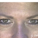 Transconjunctival Blepharoplasty